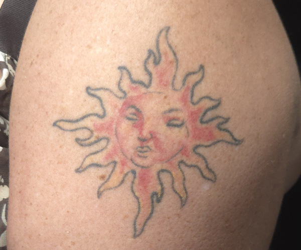 old and faded sun tattoo showing the before state of this coverup tattoo